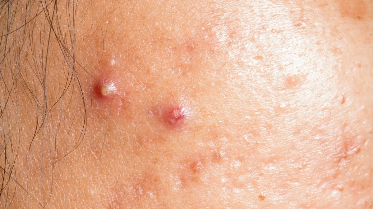 Dấu hiệu nhận biết mụn trứng cá do stress