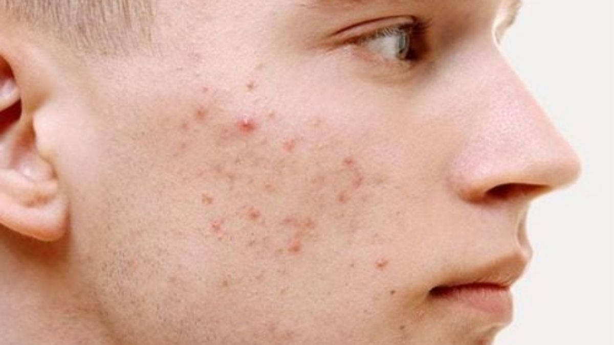 Biểu hiện nhận biết mụn trứng cá mủ