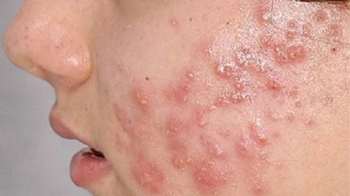 Mụn lan rộng, sưng to, có hiện tượng viêm sâu, dễ để lại sẹo lõm và tổn thương lâu dài cho da.