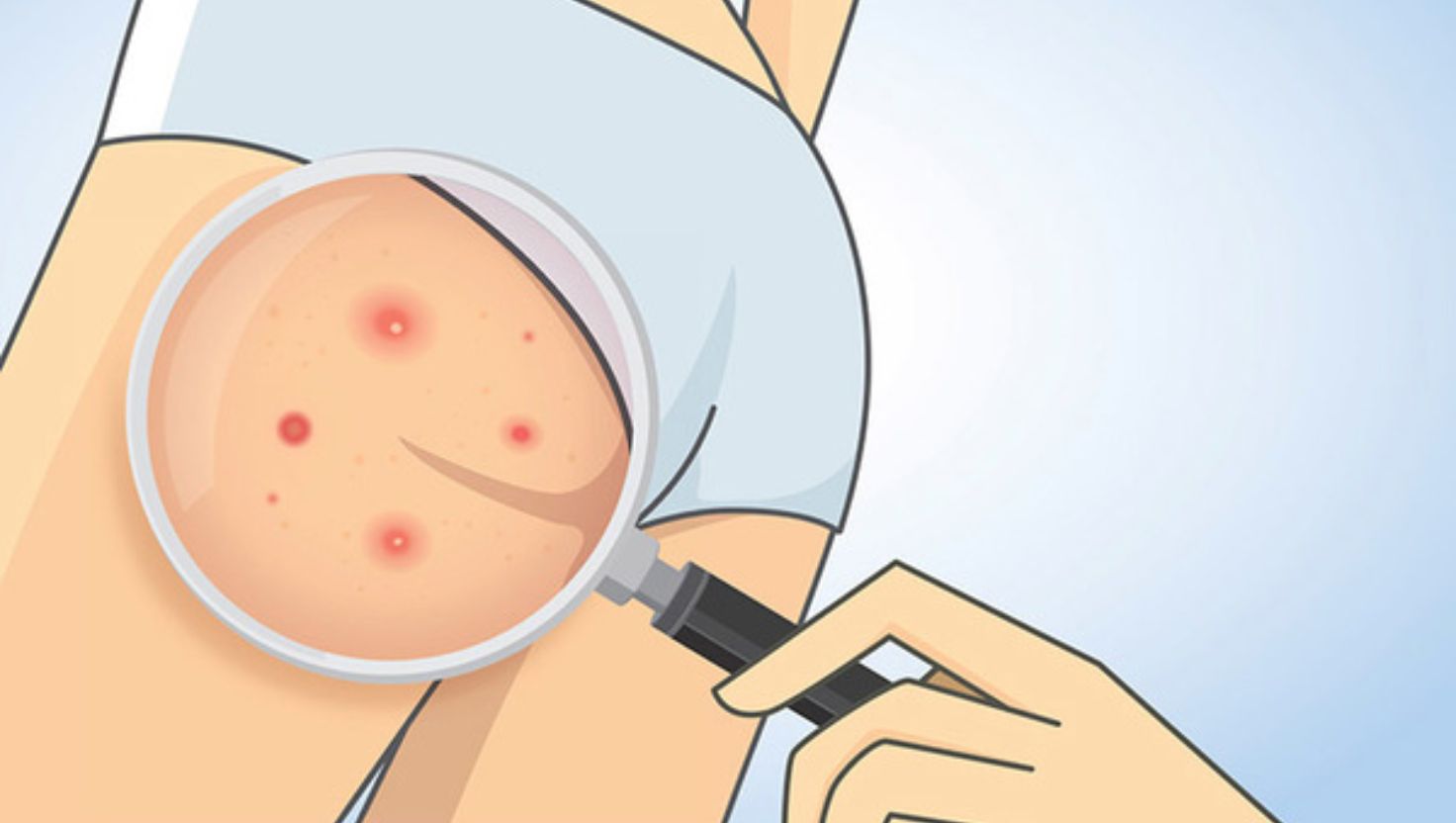 Nguyên nhân phổ biến gây mụn trứng cá ở mông