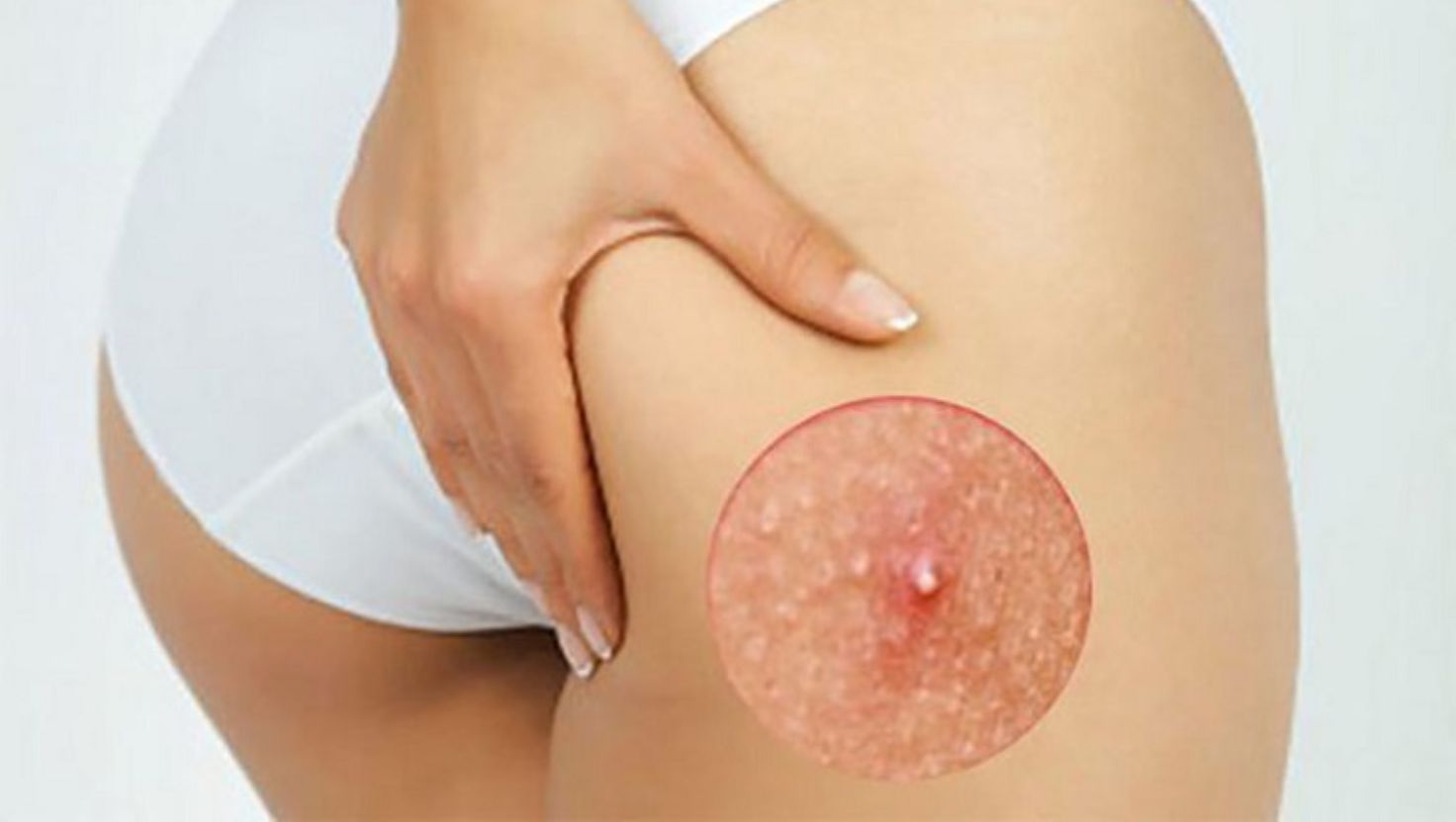 Phân biệt mụn trứng cá ở mông và các loại mụn khác