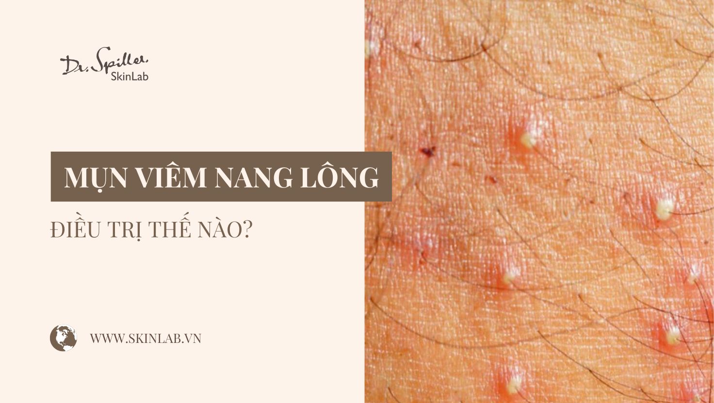 Điều trị mụn viêm nang lông lưng hiệu quả