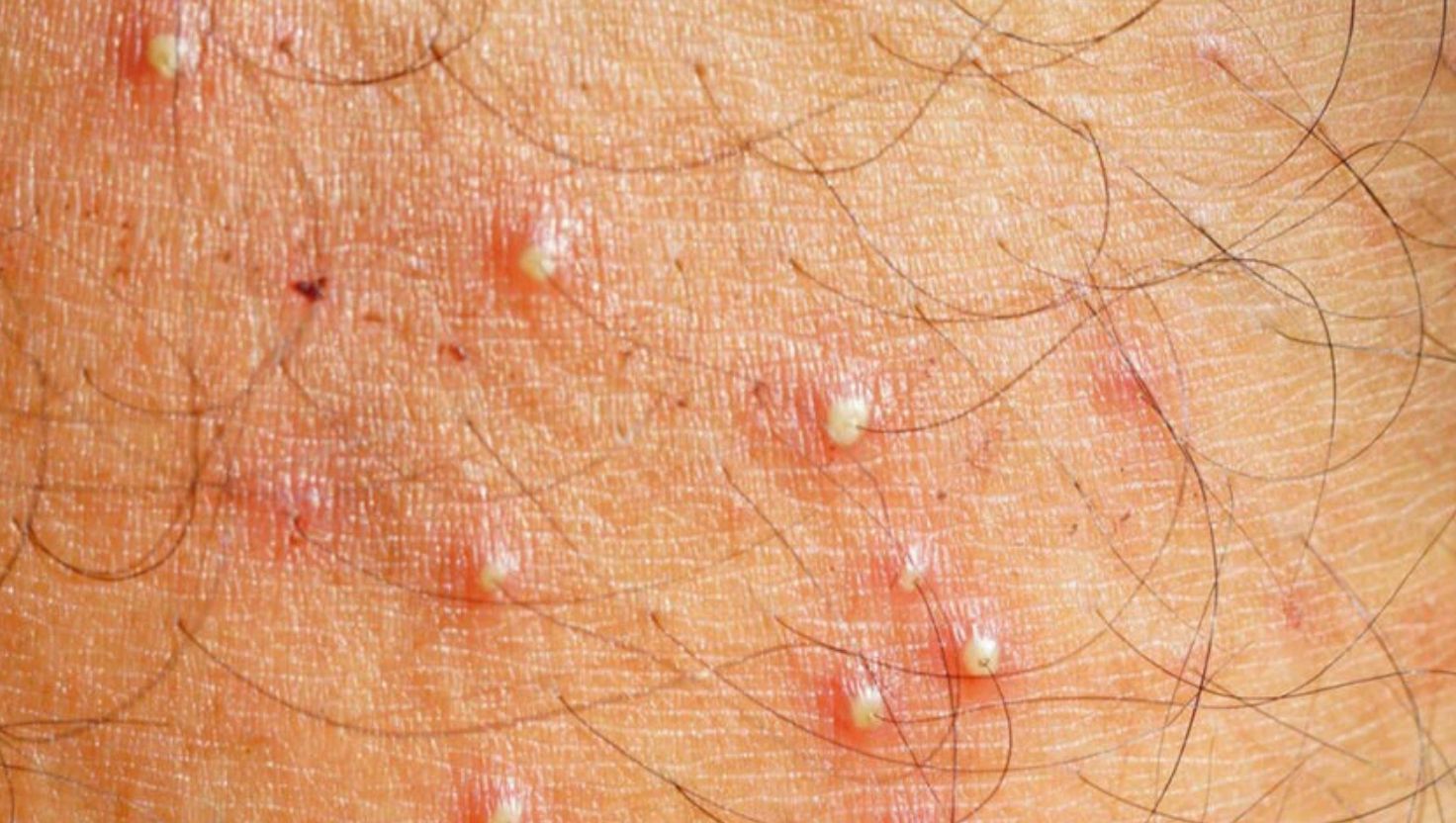 Mụn viêm nang lông lưng: Giải mã nguyên nhân