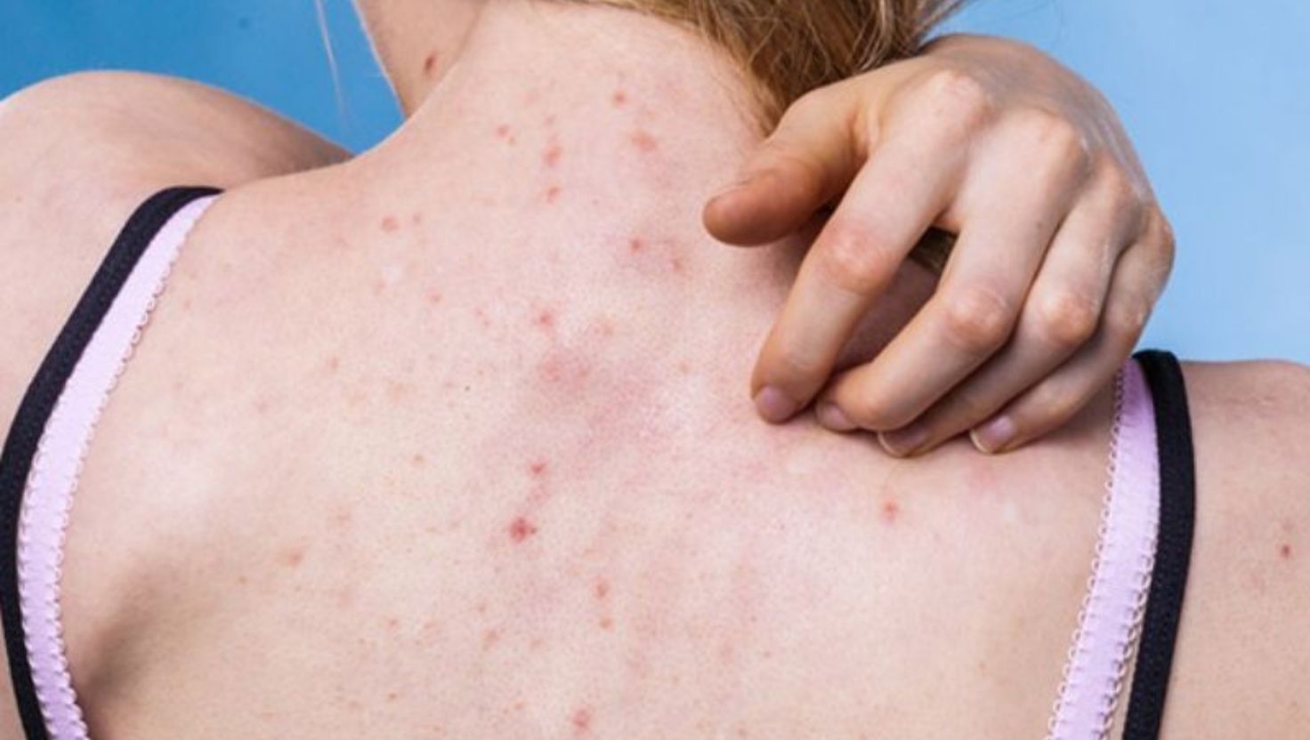 Triệu chứng nhận biết mụn viêm nang lông lưng