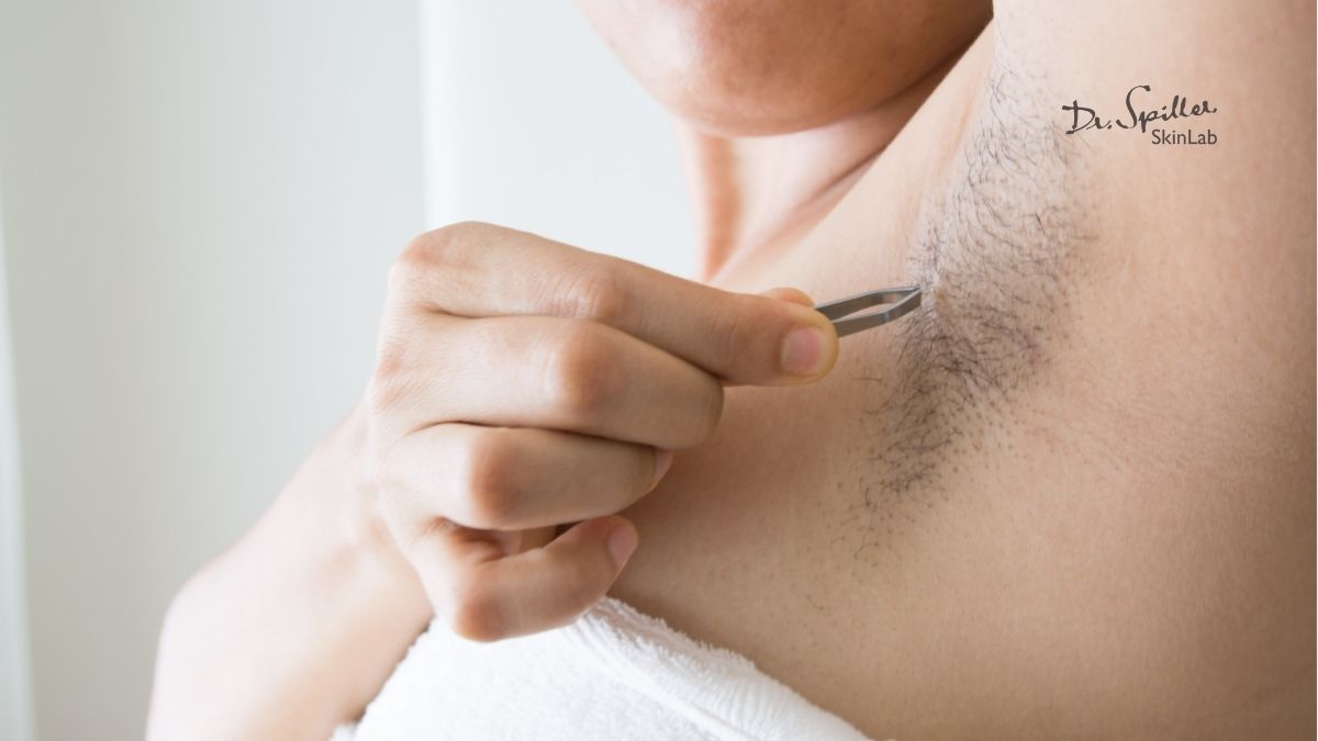 Thói quen cạo, nhổ lông không đúng cách khiến nách bị thâm