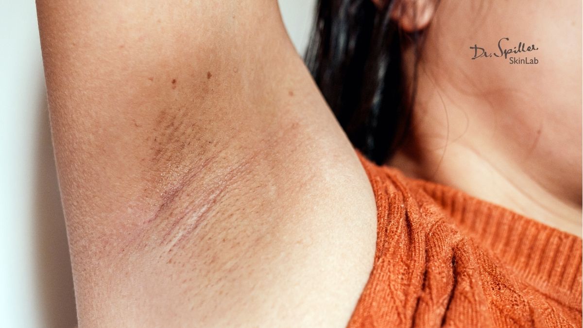 Nách bị thâm có nguy hiểm không?