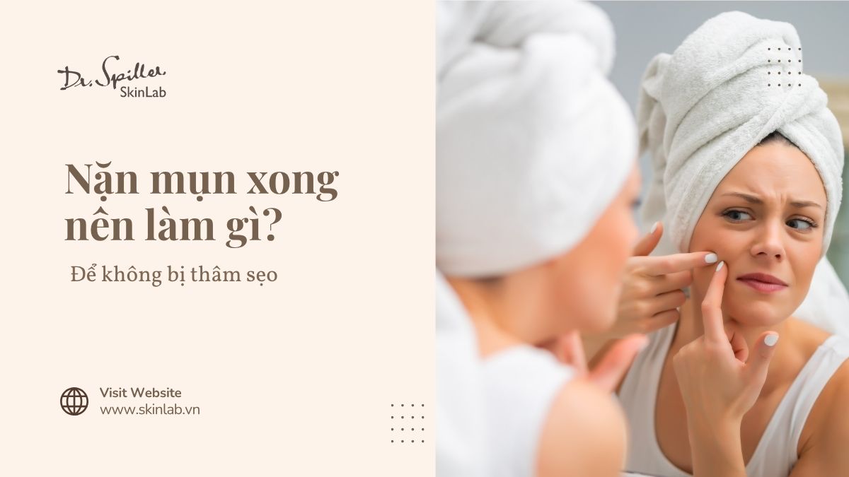 Nặn mụn xong nên làm gì? 10 cách nên làm để không bị thâm sẹo
