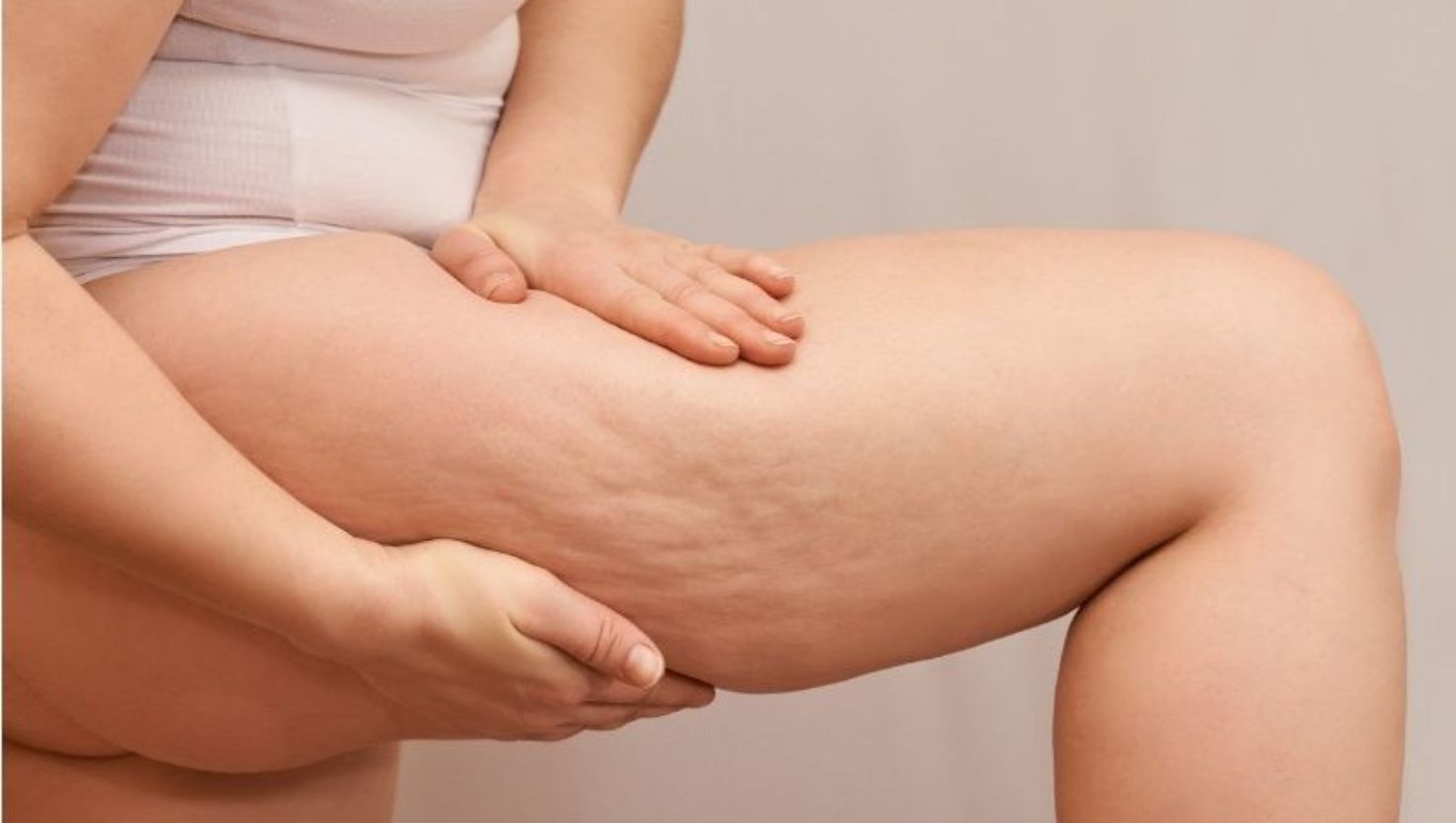 Da ở những vùng đùi có thể bị giãn quá mức, làm giảm độ đàn hồi và hình thành nếp nhăn