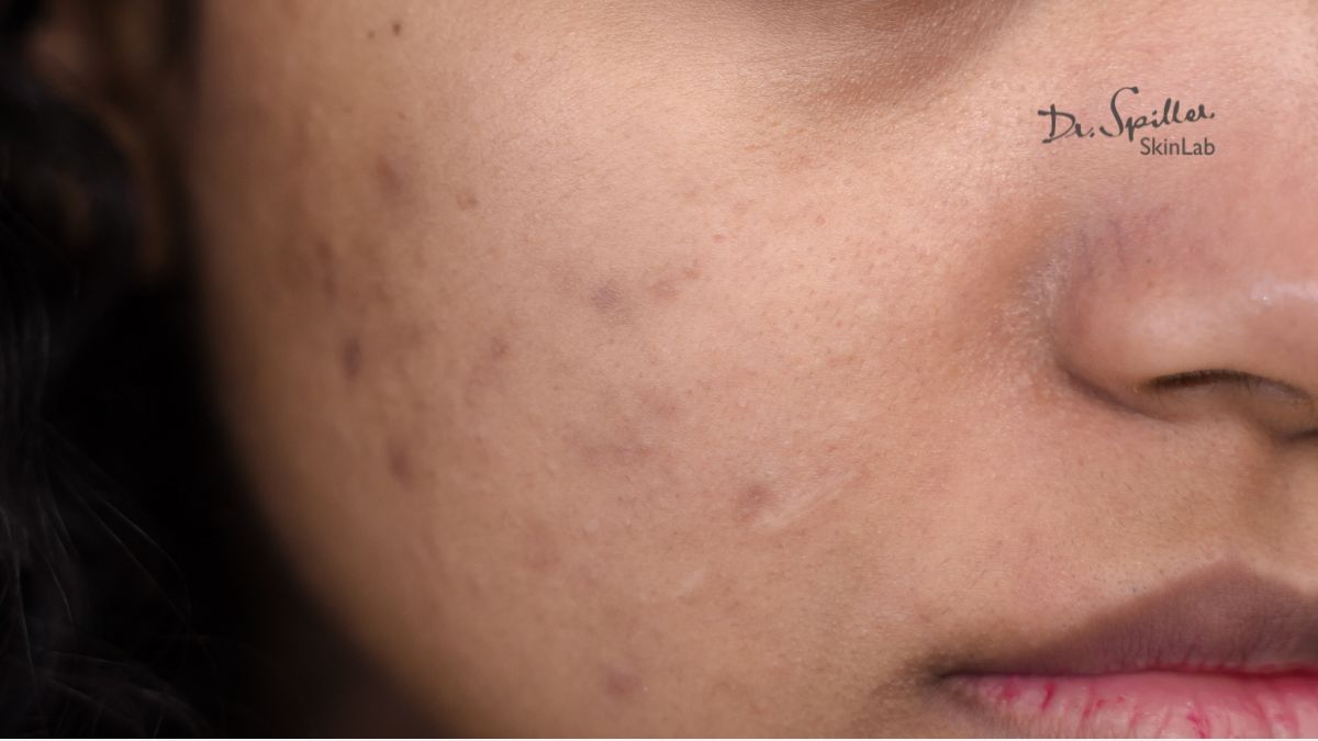 Niacinamide trị mụn thâm có thực sự hiệu quả?