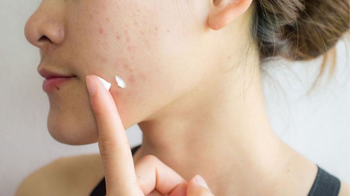 Các nồng độ Tretinoin phổ biến hiện nay