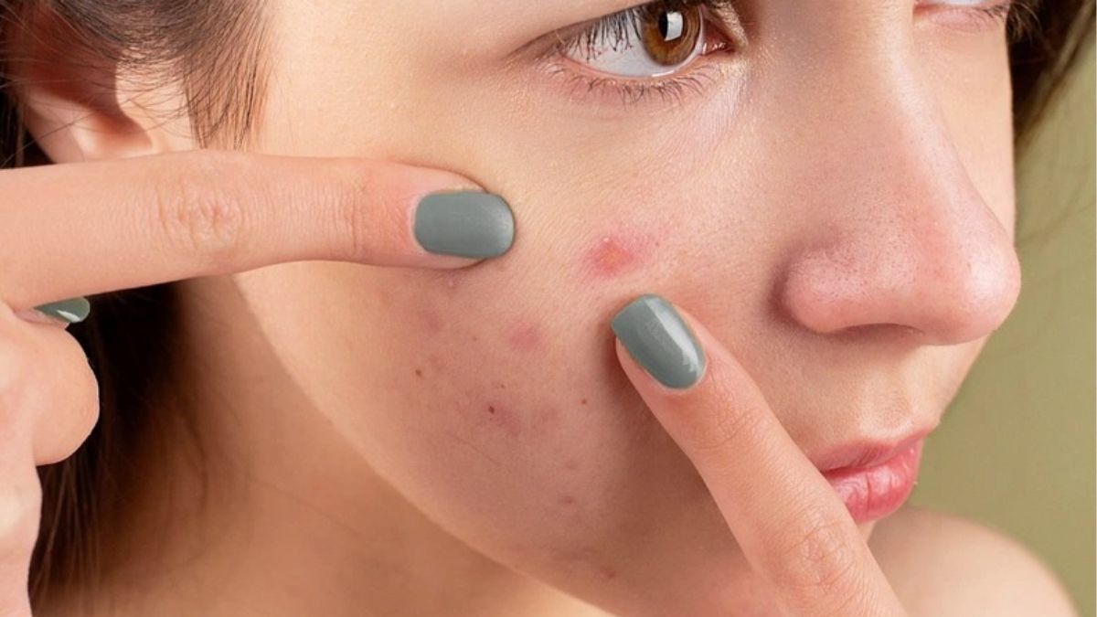 Cơ chế hoạt động của peel da trị mụn