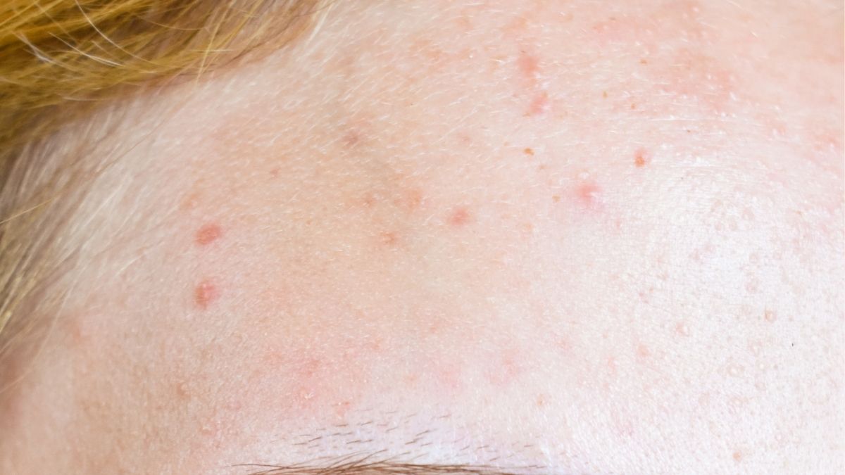 Các loại mụn phù hợp sử dụng Salicylic acid