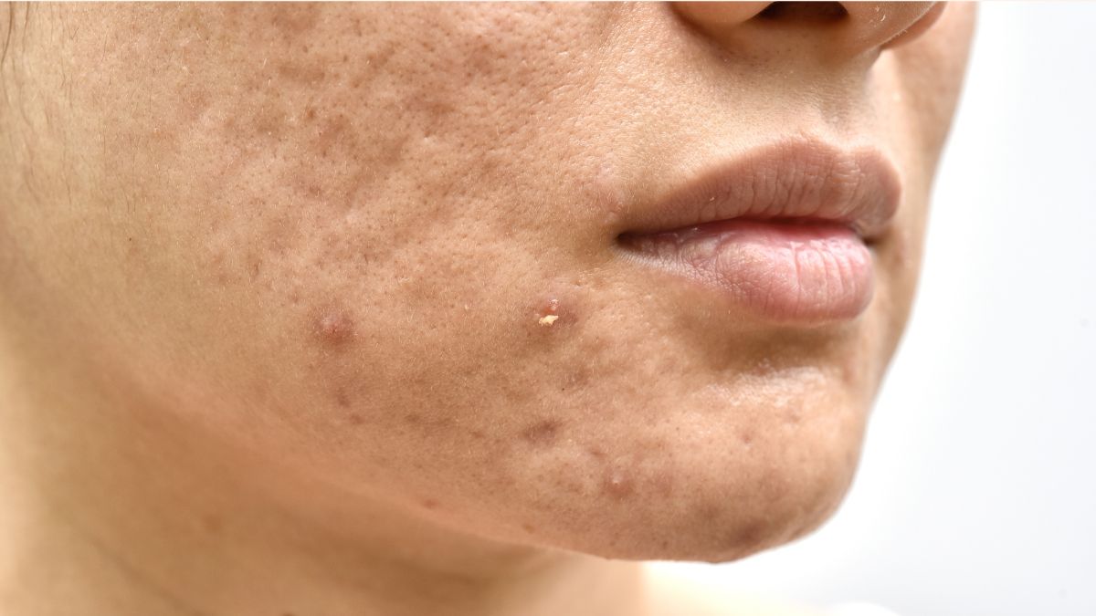 Nguyên nhân hình thành sẹo mụn và các yếu tố nguy cơ