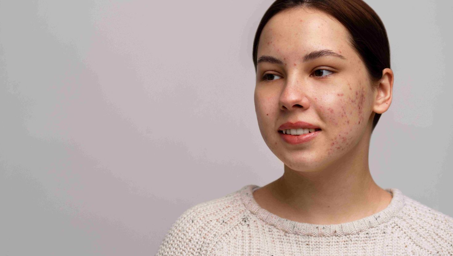 Phân biệt giữa mụn dị ứng và mụn thông thường