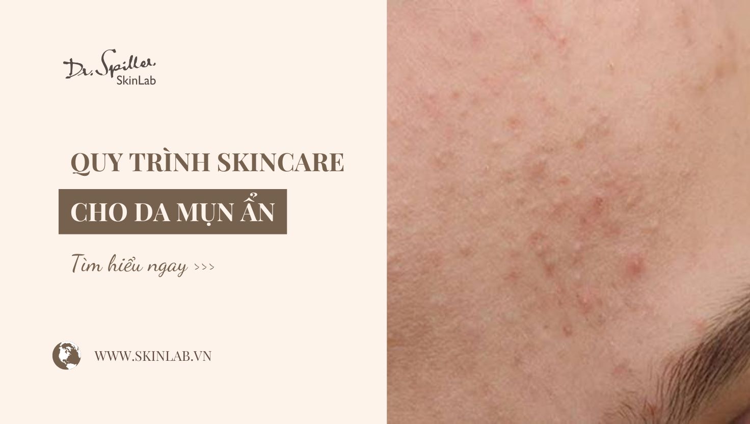 Skincare cho da mụn ẩn: Chu trình chăm sóc da hiệu quả
