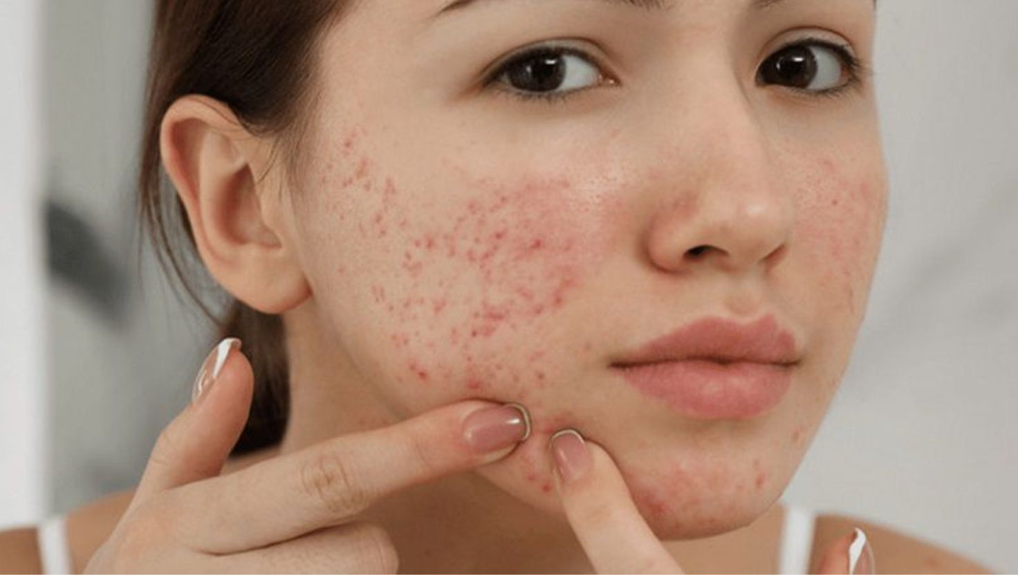 Tại sao phải skincare sau khi nặn mụn?