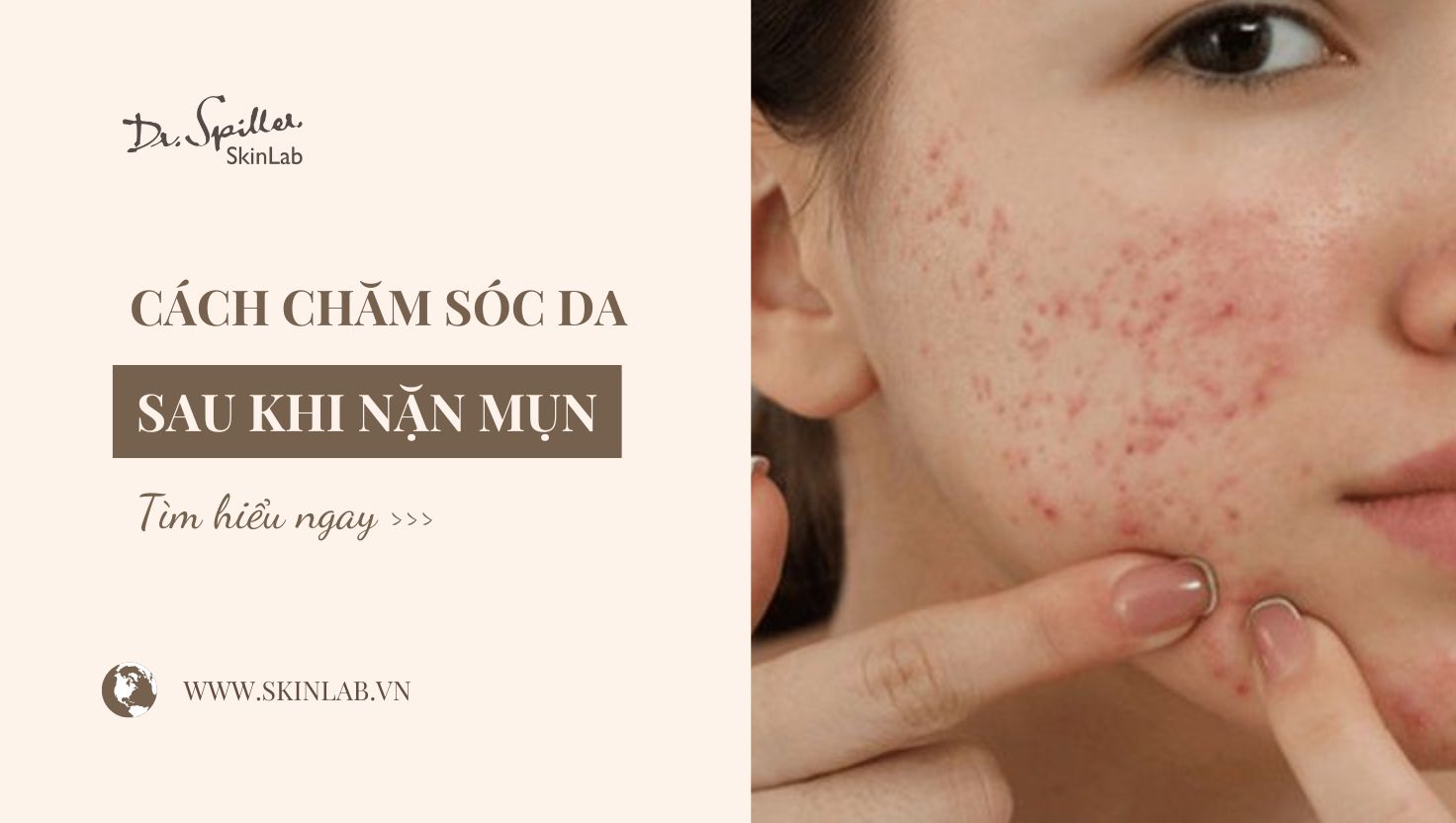 Skincare sau khi nặn mụn: Cách chăm sóc da an toàn, hiệu quả