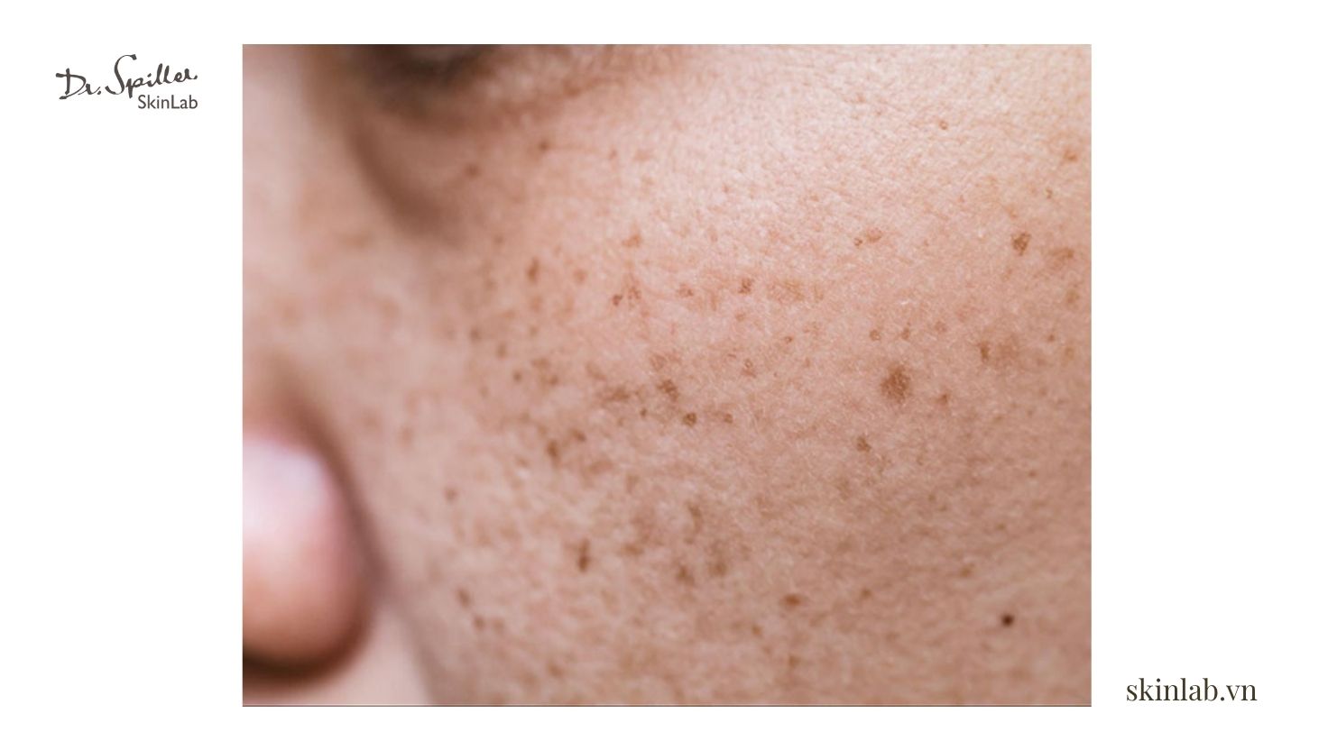 Những thành phần trị tàn nhang nổi bật trong các sản phẩm chăm sóc da hiện nay