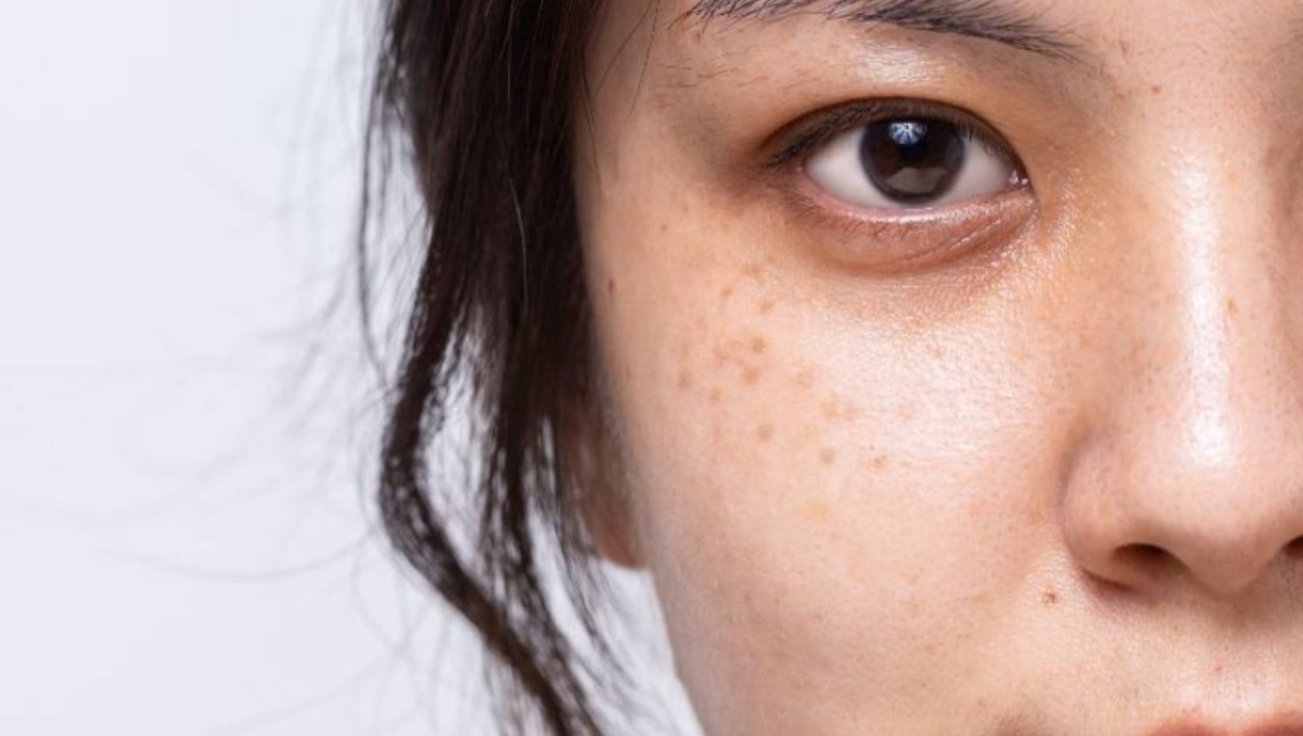 3+ thành phần trị tàn nhang giúp sáng da, mờ đốm nâu