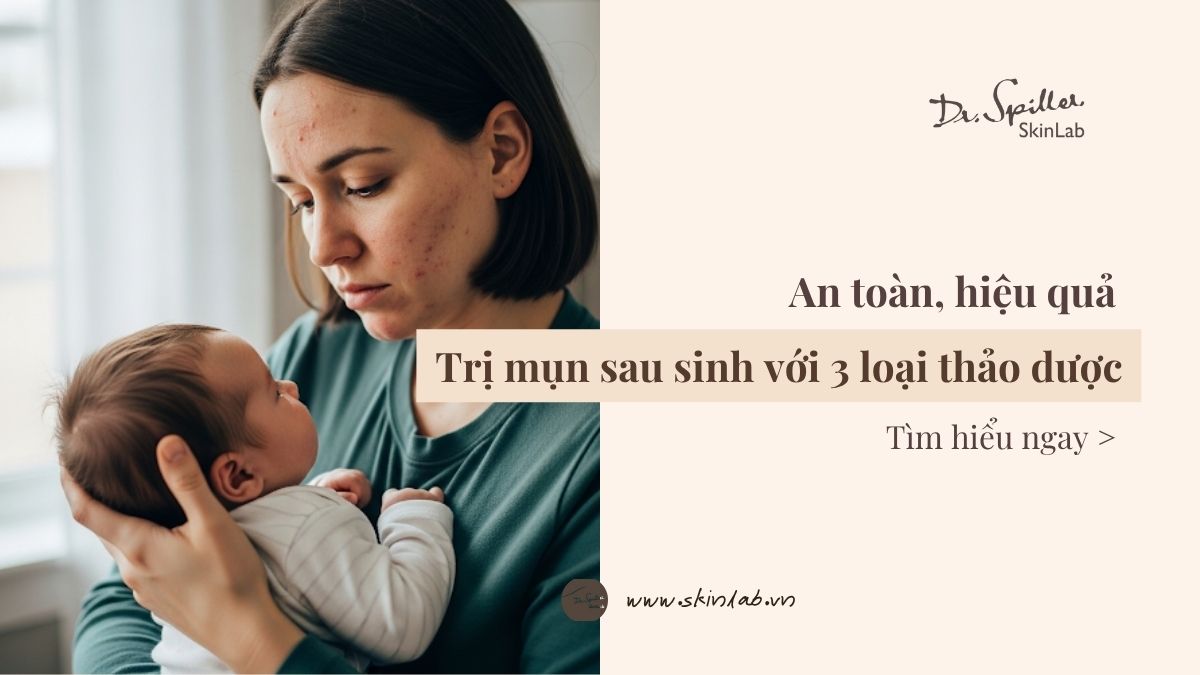 An toàn, hiệu quả: Trị mụn sau sinh với 3 loại thảo dược