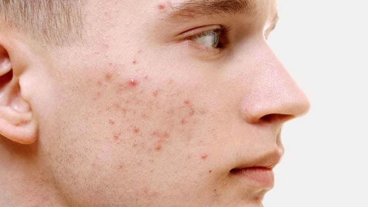 Nguyên nhân phổ biến gây mụn ở tuổi dậy thì nam