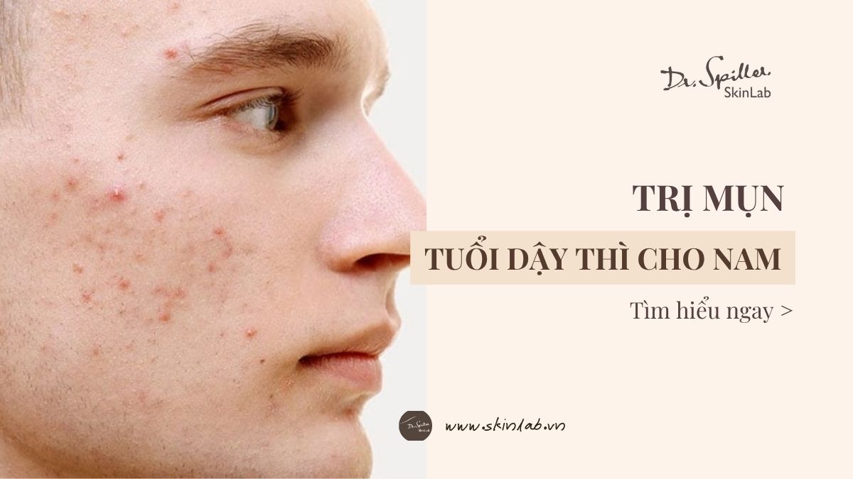 Trị mụn tuổi dậy thì nam tại nhà hiệu quả, dễ thực hiện