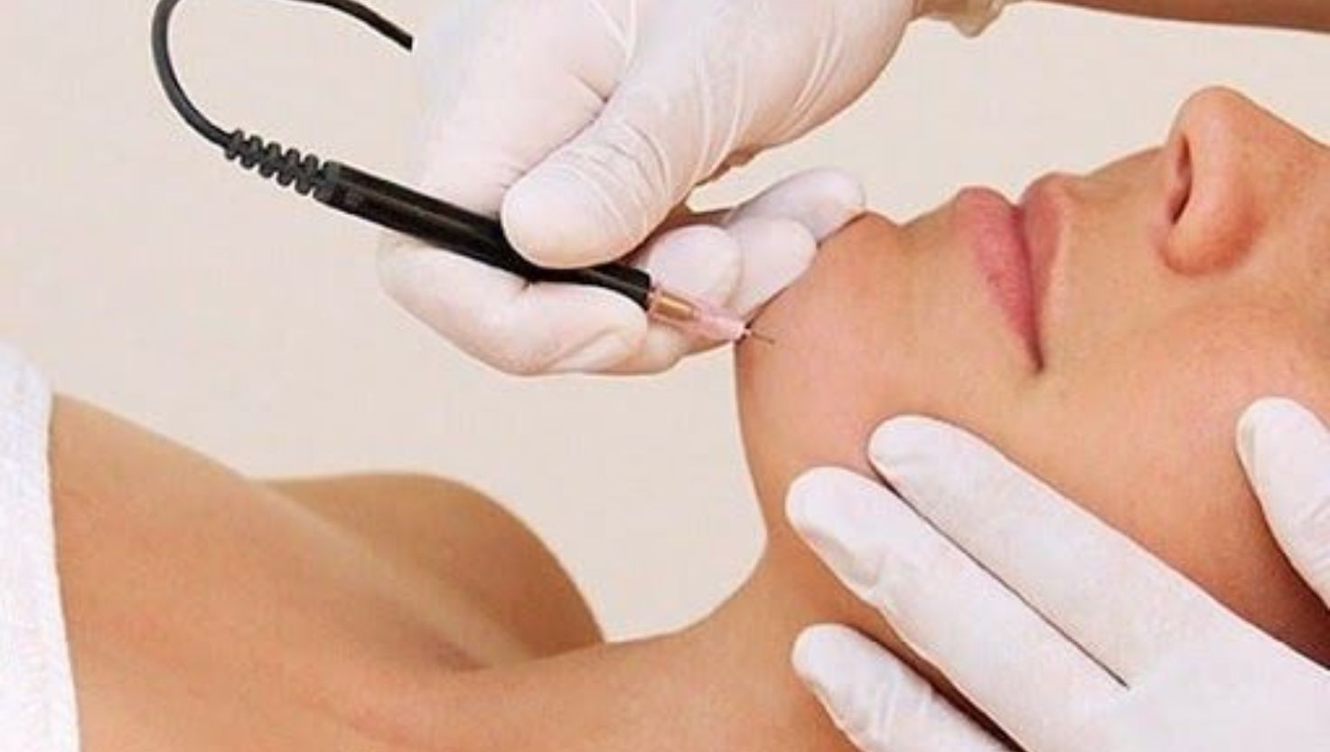 Triệt lông điện phân hiệu quả cao, phù hợp mọi loại da