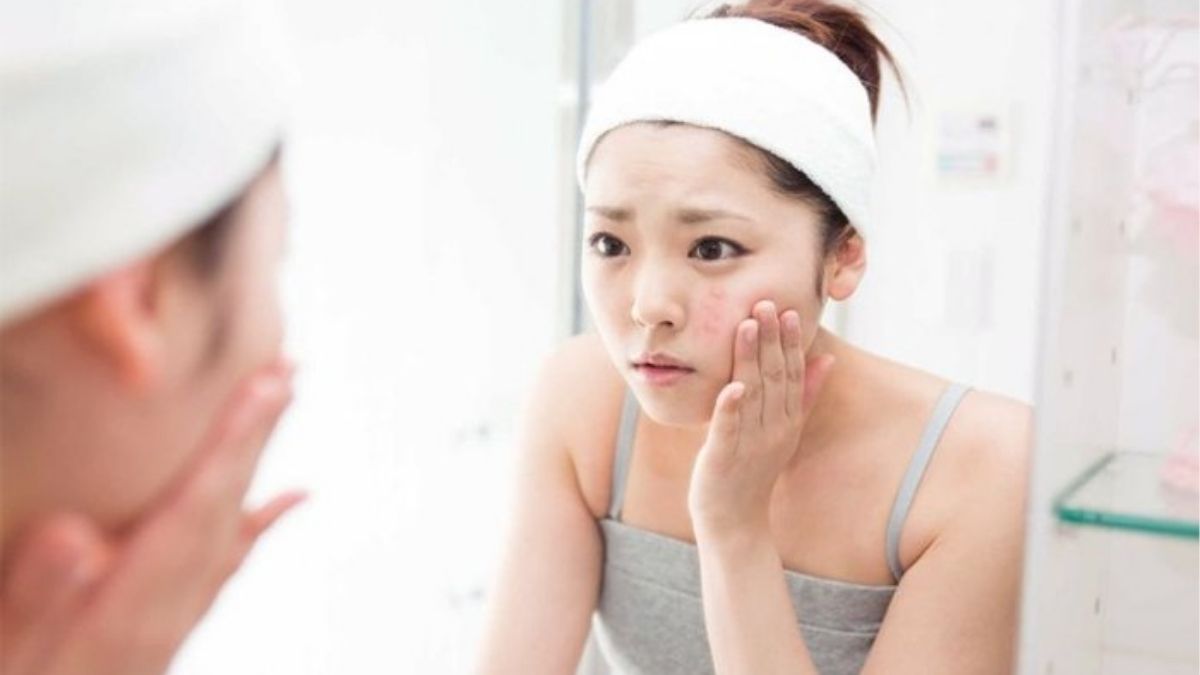 Mụn tuổi dậy thì là một trong những vấn đề phổ biến nhất mà hầu hết các bạn trẻ gặp phải trong giai đoạn này