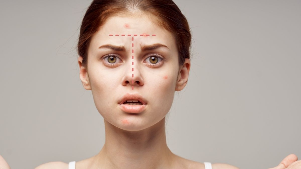 Vùng chữ T là gì? Hiểu đúng và chăm sóc da vùng T hiệu quả