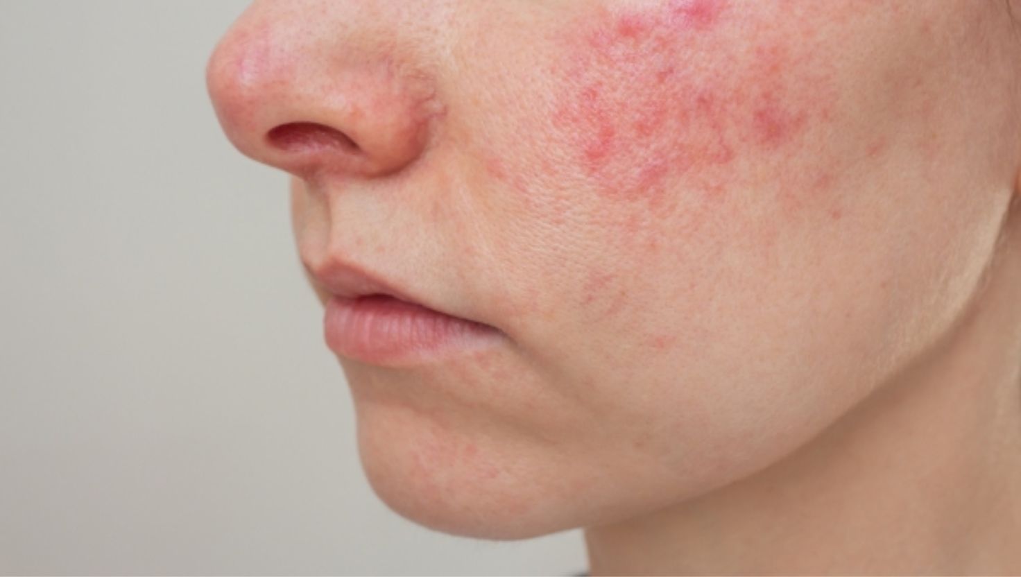 Cách giảm mẩn đỏ cho da nhạy cảm