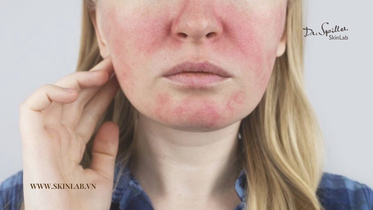 Vì Sao Da Nhạy Cảm Cần Chăm Sóc Đặc Biệt Sau Peel?