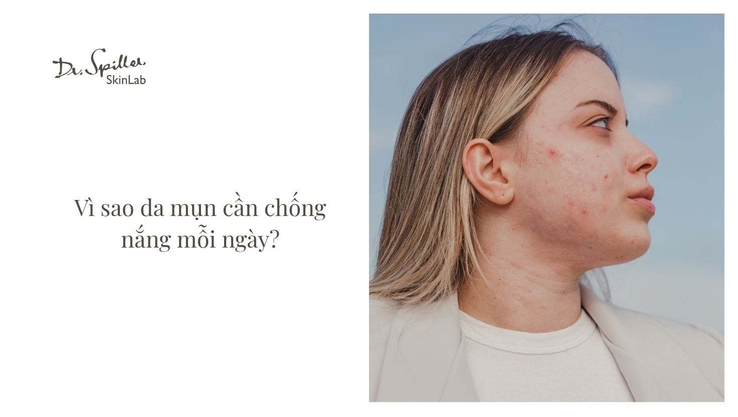 Chống nắng đúng cách sẽ giúp da mụn phục hồi nhanh hơn, giảm nguy cơ hình thành thâm, sẹo và giữ được làn da đều màu.