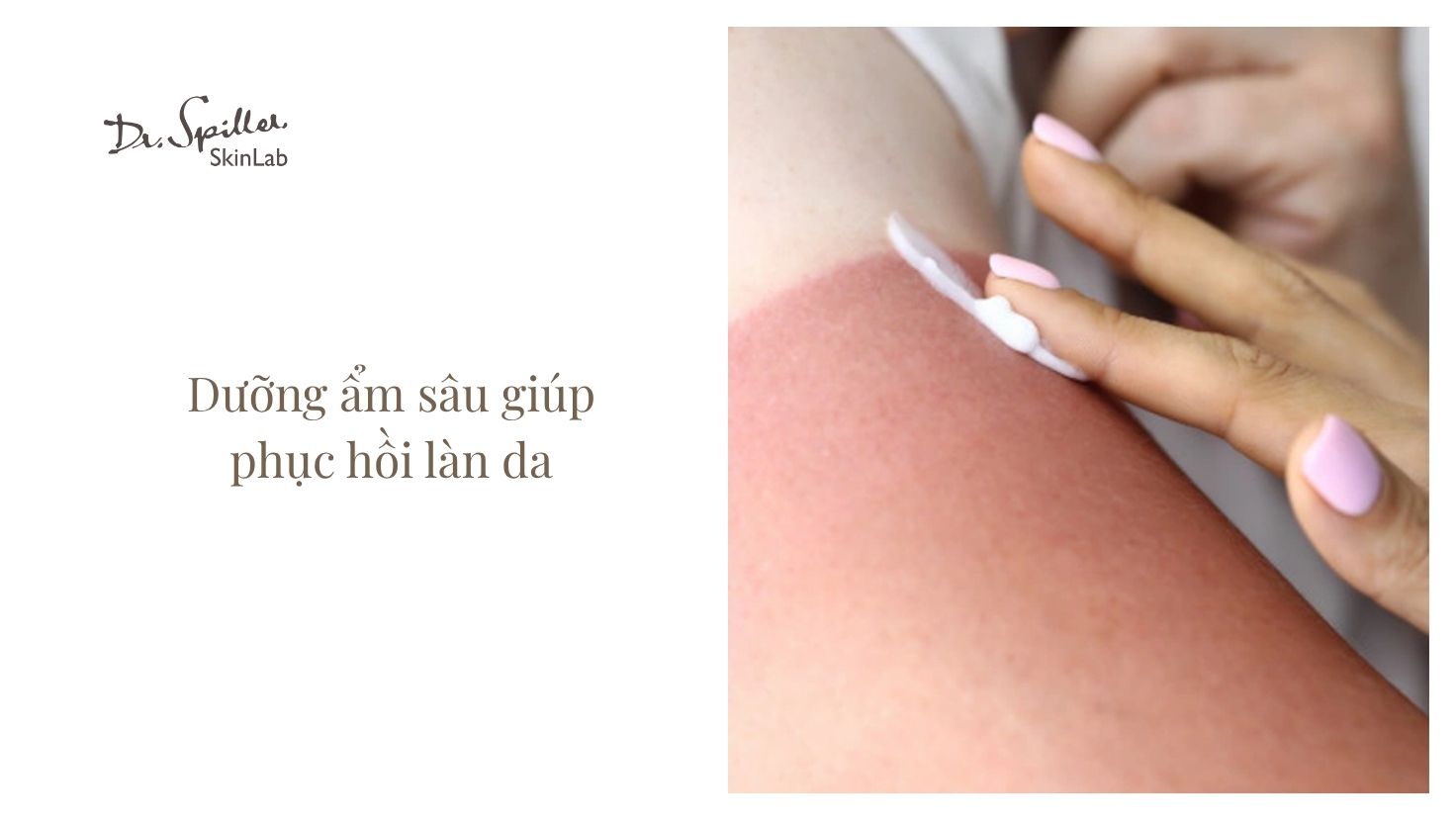 Các bước chăm sóc da cháy nắng mùa hè trong nhật ký làm đẹp