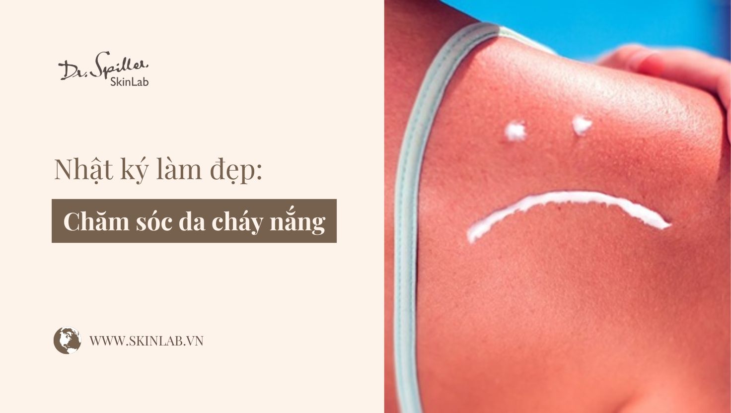 da cháy nắng mùa hè