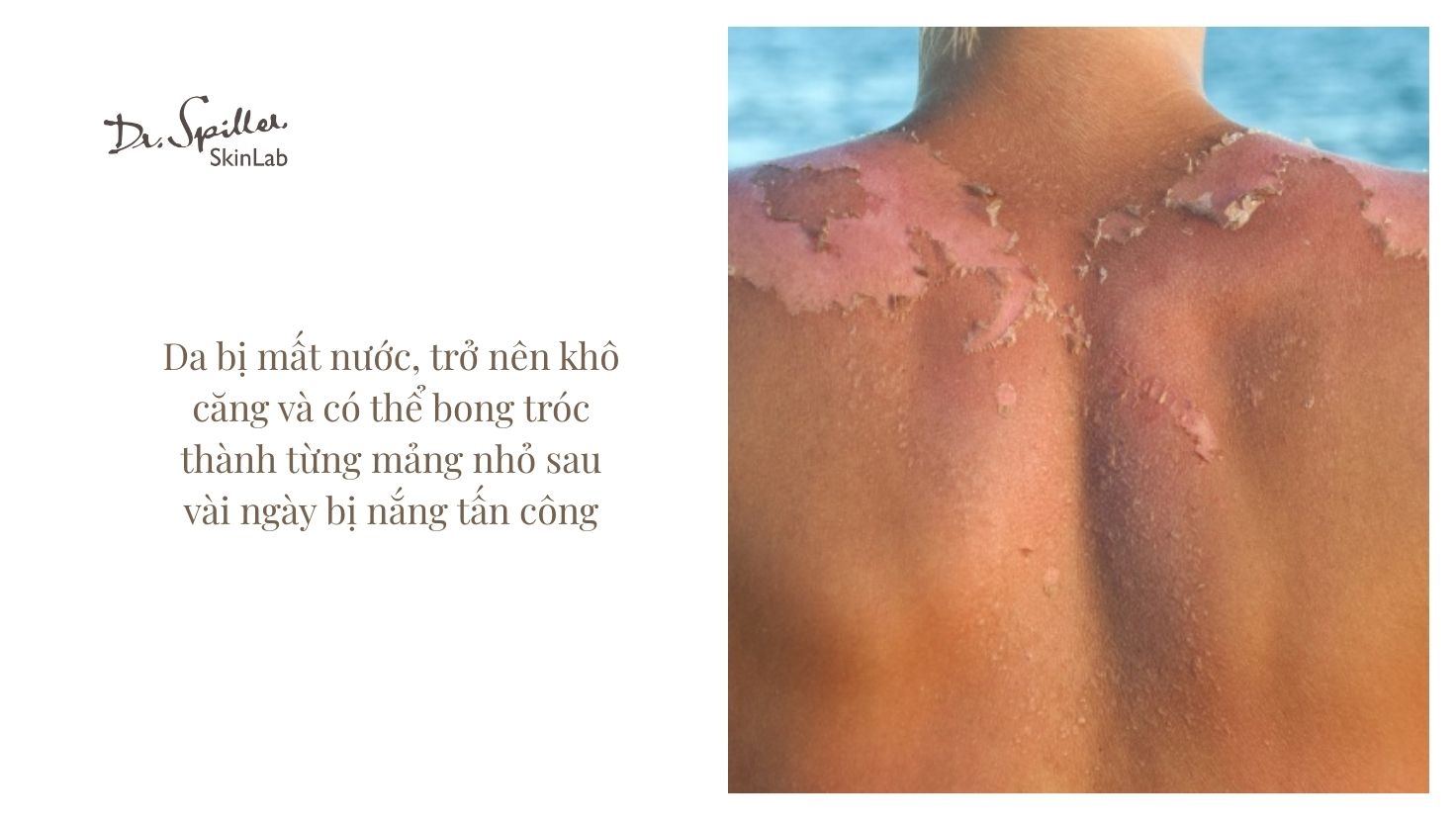 Những triệu chứng phổ biến khi bị da cháy nắng mùa hè