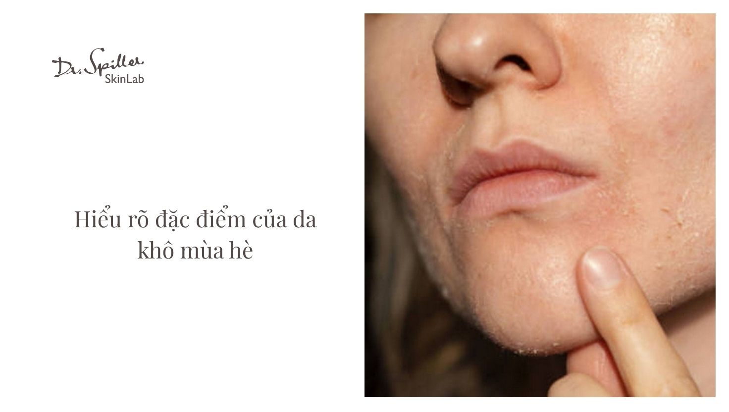 Mùa hè với nắng nóng gay gắt khiến da khô dễ mất đi lượng dầu tự nhiên, trở nên khô rát và bong tróc