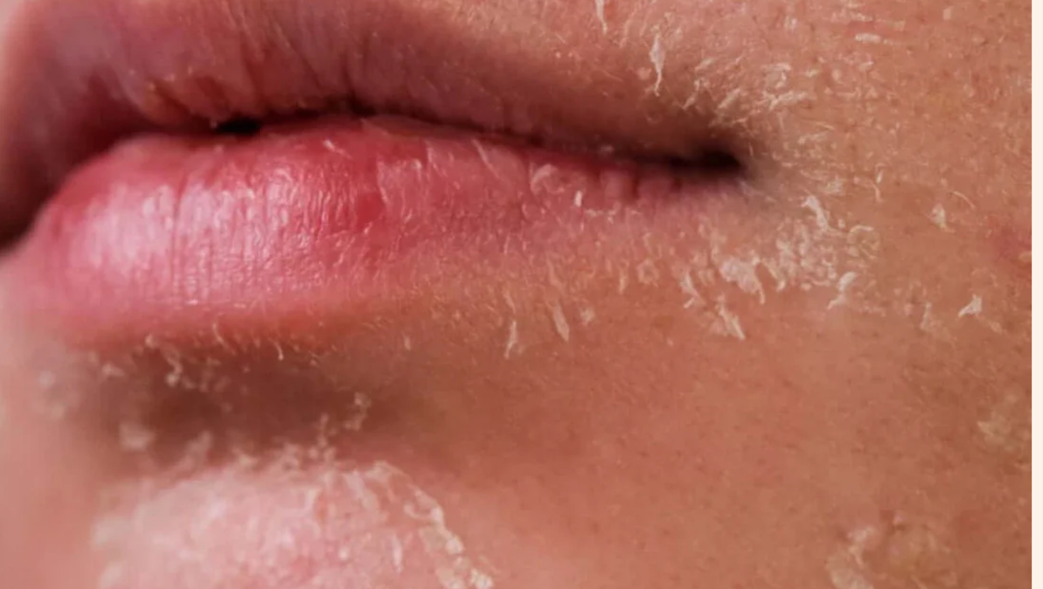 Dấu hiệu nhận biết da nhạy cảm bị bong tróc và tác động tiêu cực