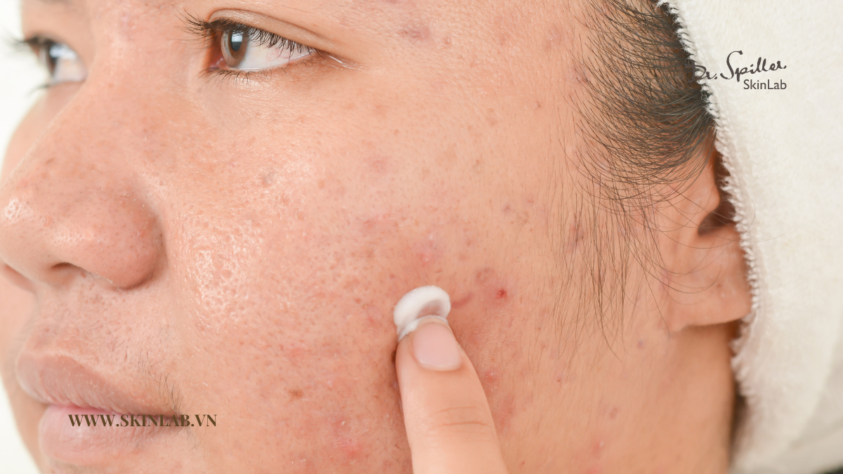 Da nhạy cảm bị mụn cần độ ẩm để duy trì sự cân bằng