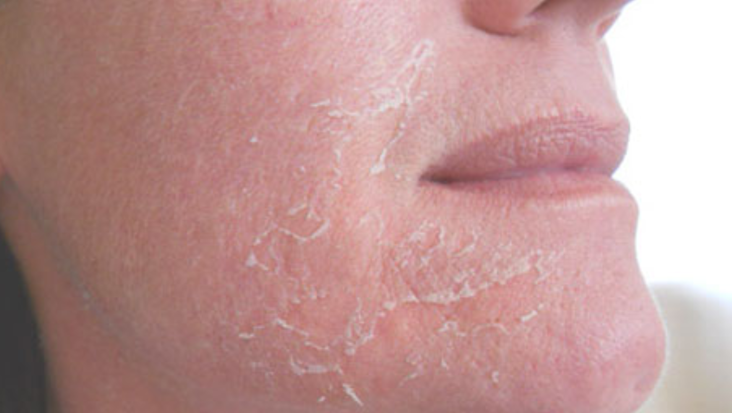 Da nhạy cảm dễ kích ứng