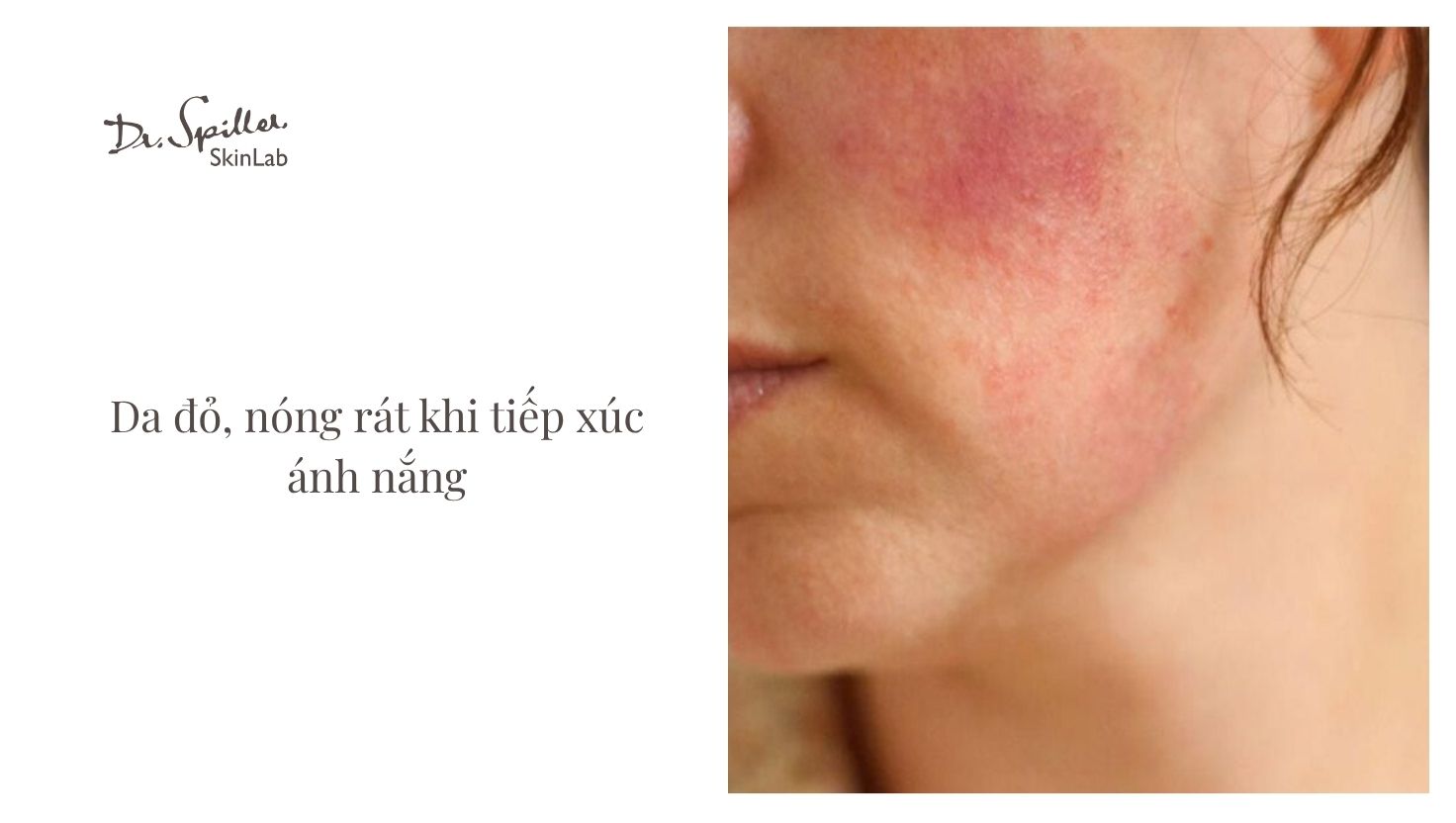 Hiểu rõ đặc điểm của da nhạy cảm mùa hè là bước đầu tiên để lựa chọn cách chăm sóc phù hợp.