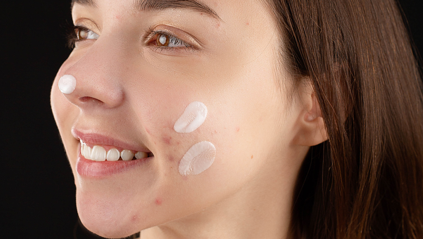 Nguyên nhân khiến da nhạy cảm dễ nổi mụn