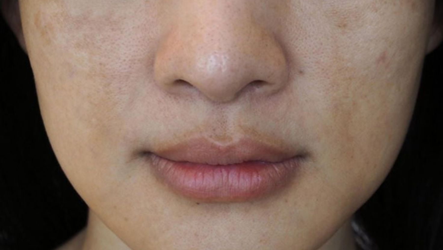 Hiểu rõ nguyên nhân là bước đầu tiên giúp chọn lựa giải pháp cho da nhạy cảm bị sạm màu phù hợp