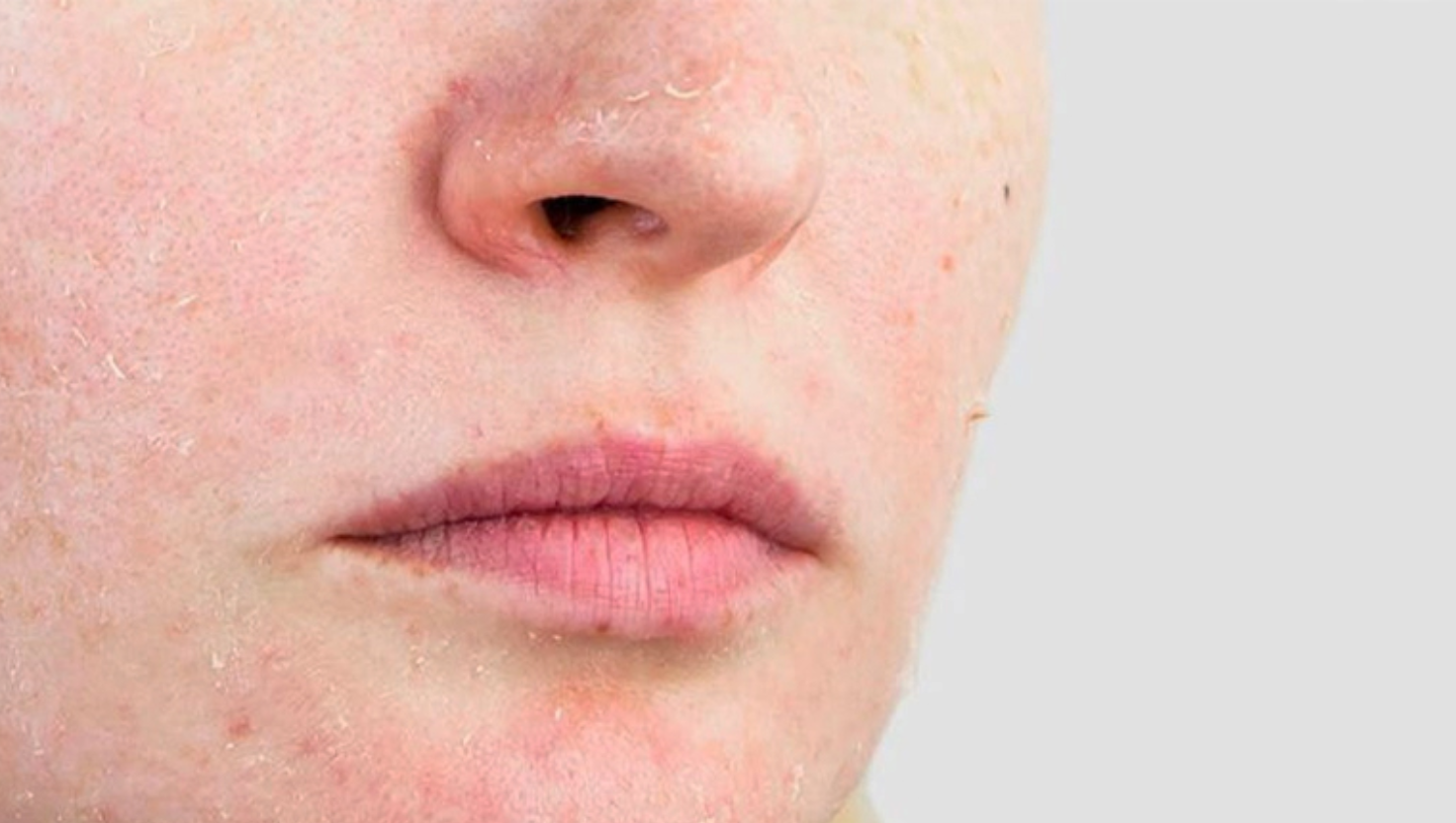 Glycerin có phải là "cứu tinh" cho da nhạy cảm?