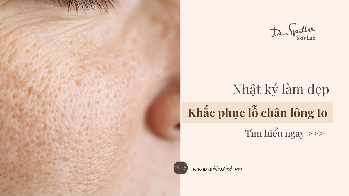 Dấu hiệu nhận biết lỗ chân lông to mùa hè và hậu quả kéo dài