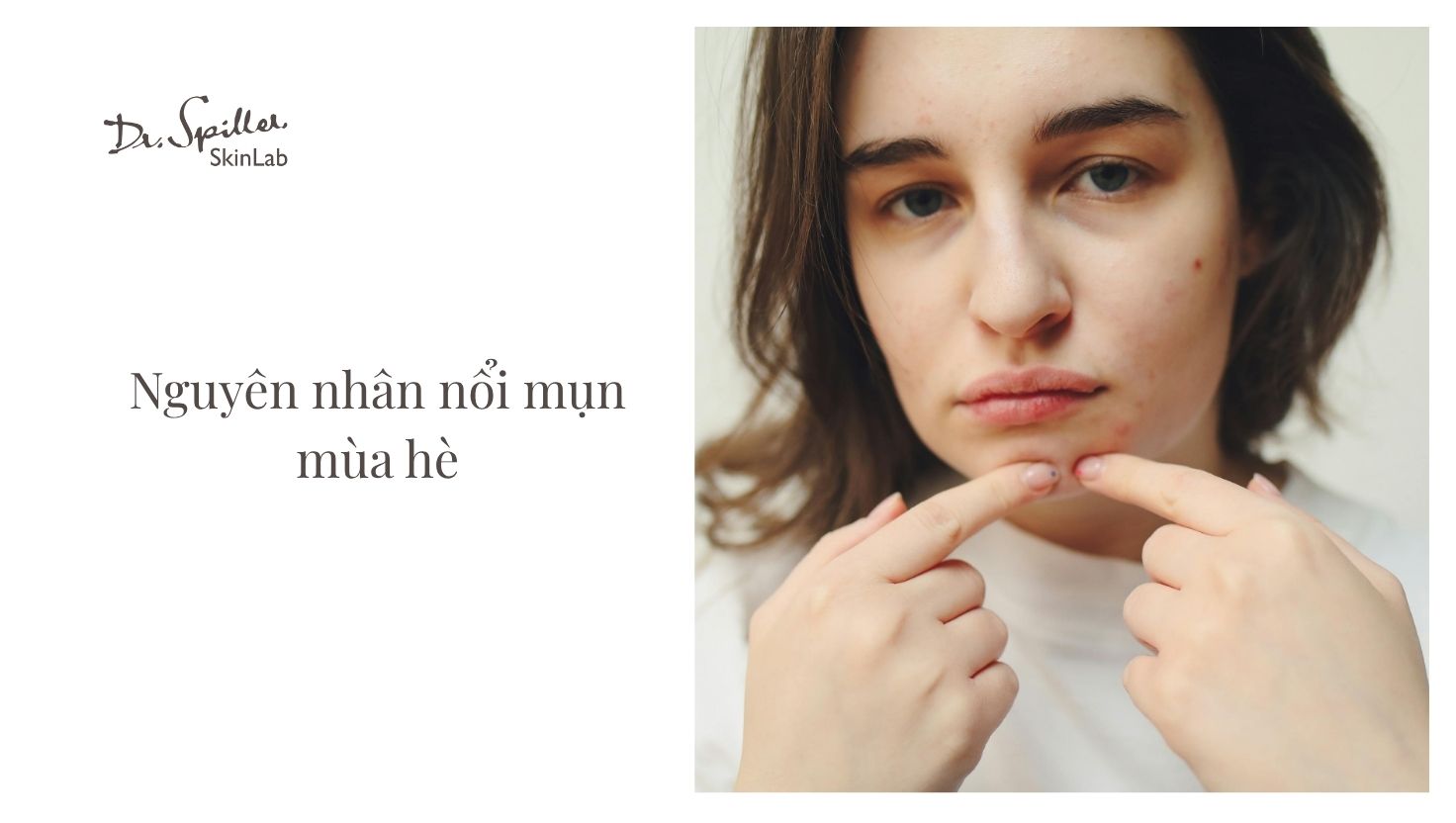 Hiểu rõ những nguyên nhân gây nổi mụn giúp bạn xây dựng phương pháp phòng tránh phù hợp