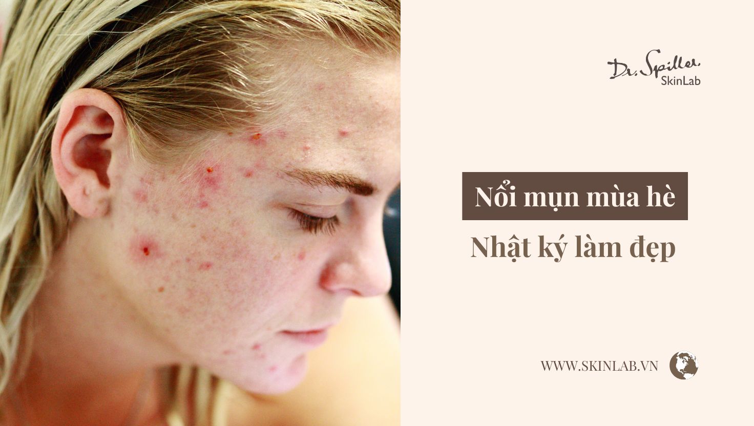 nổi mụn mùa hè