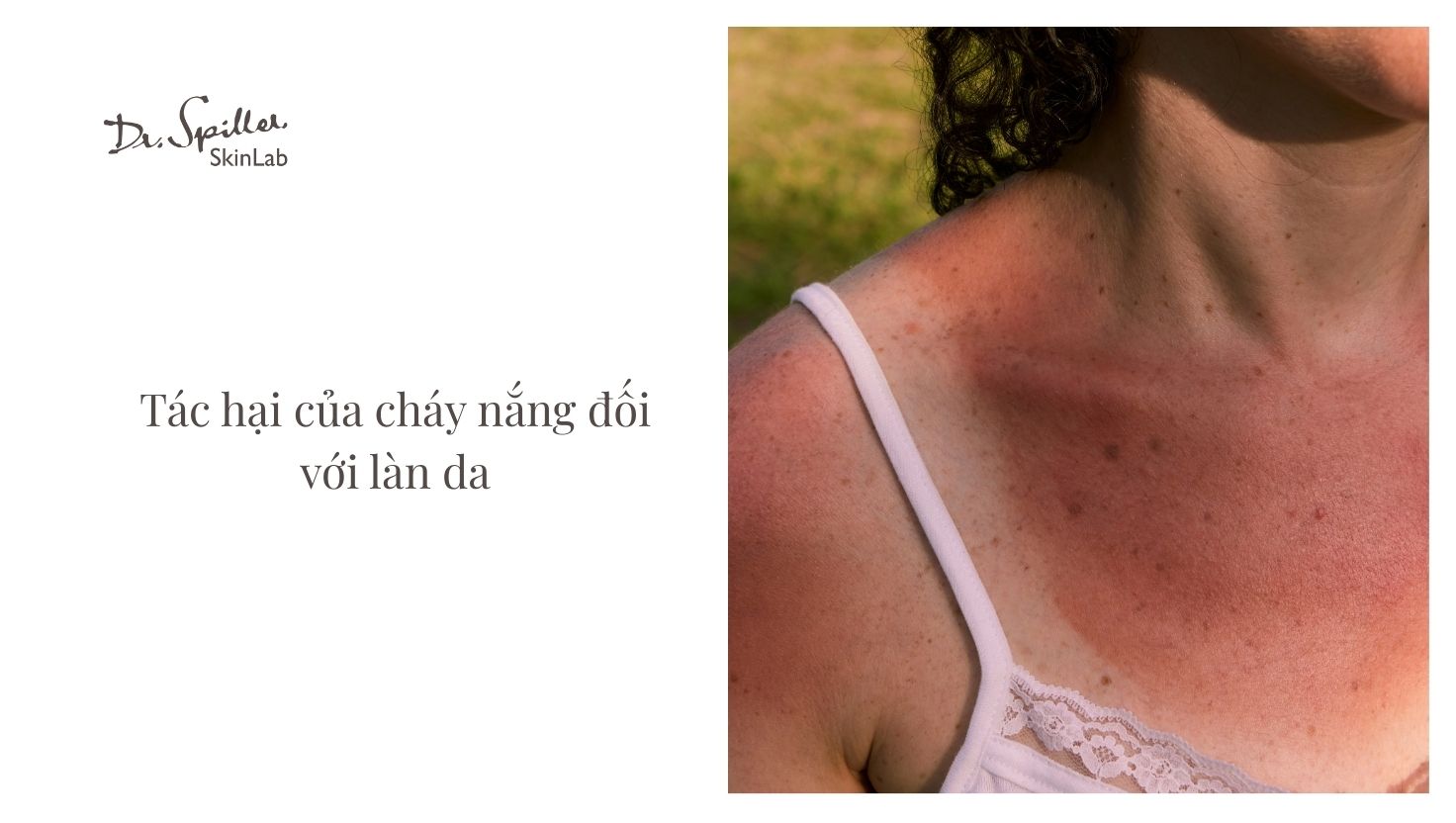 Khi cháy nắng, da thường đỏ, đau rát và có thể xuất hiện phồng rộp
