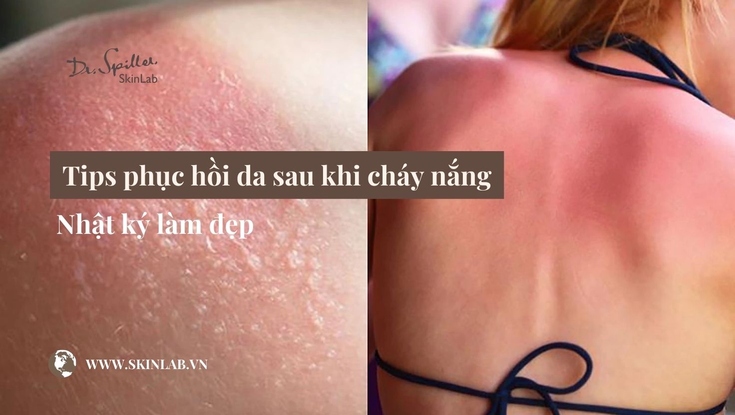 phục hồi da sau khi cháy nắng