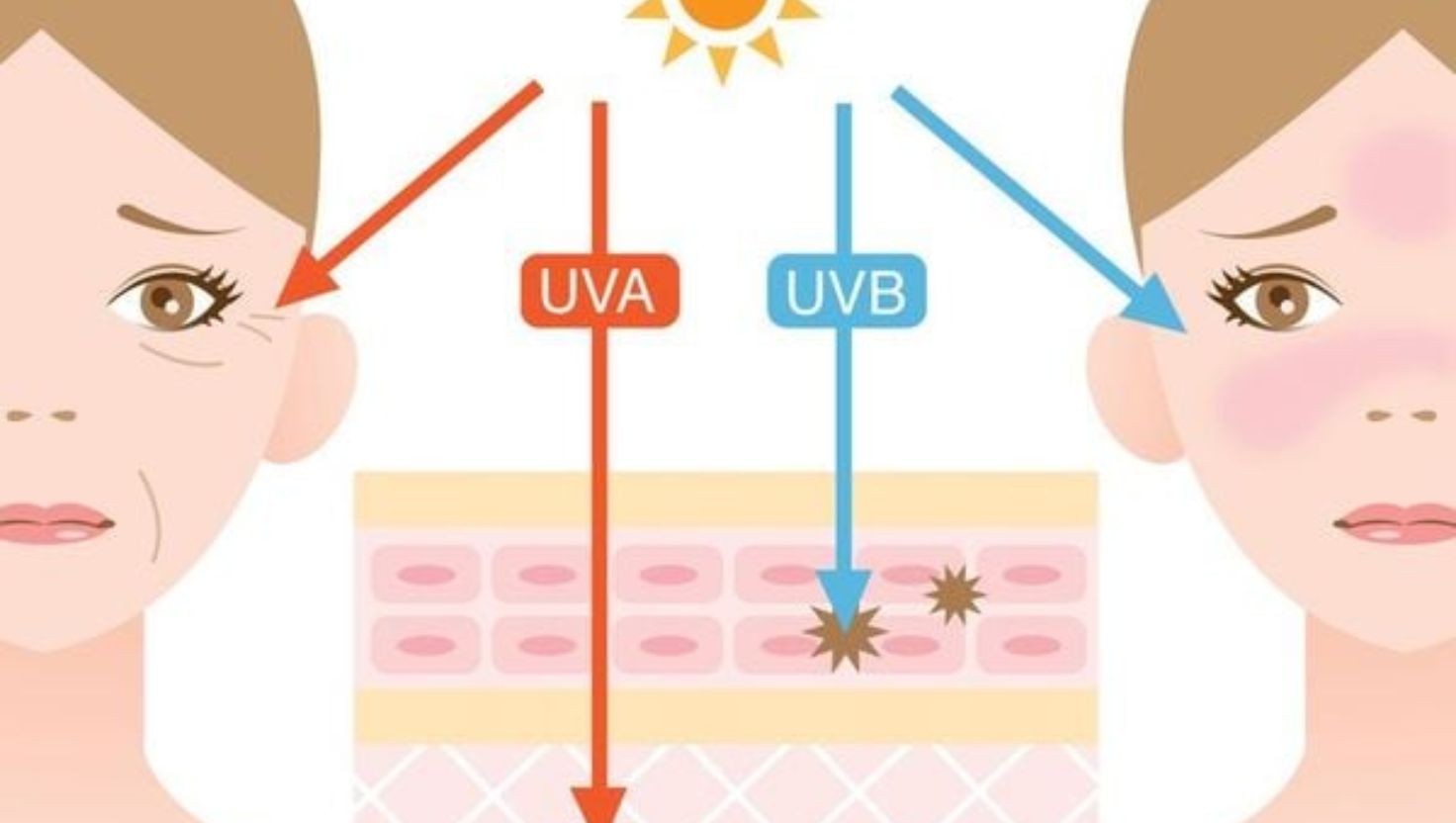 Nguyên nhân chính xuất phát từ tác động của tia cực tím (UV) trong ánh nắng mặt trời, gồm hai loại chính: UVA và UVB.