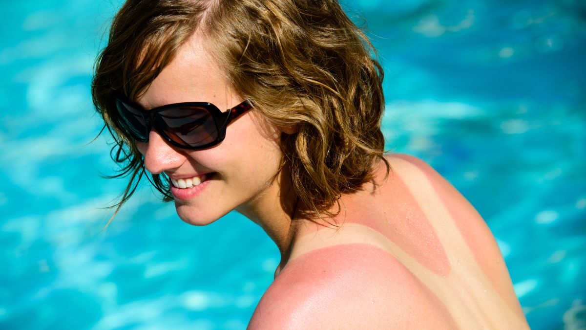 Cháy nắng và sạm da thường gặp sau khi đi biển